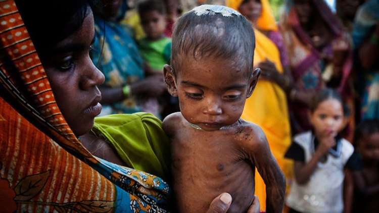 Malnutrition children death The Lancet