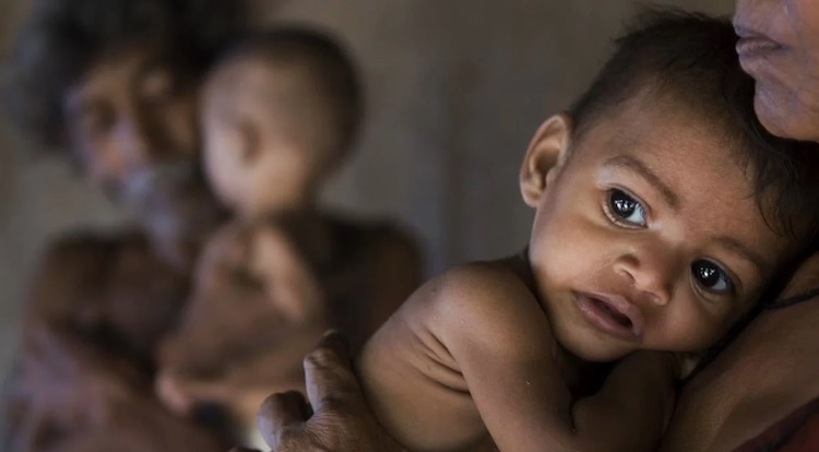 Malnutrition cases rise in Gujarat, 2 lakh 41 thou